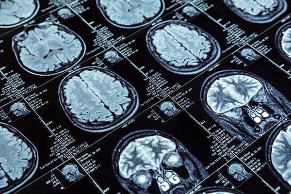 brain bank ms research australia