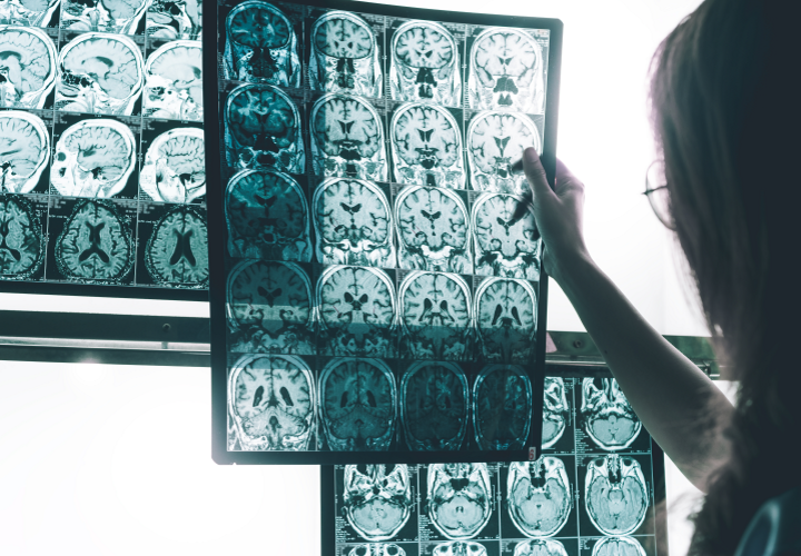 shifting goalposts for MS treatment