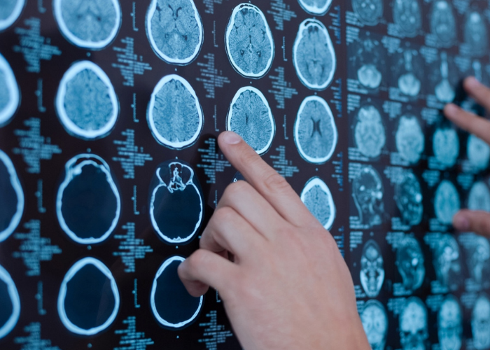 brain-scan progressive MS