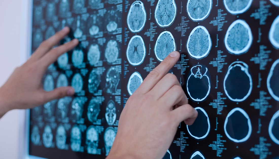 What factors affect conversion to clinically definite MS?